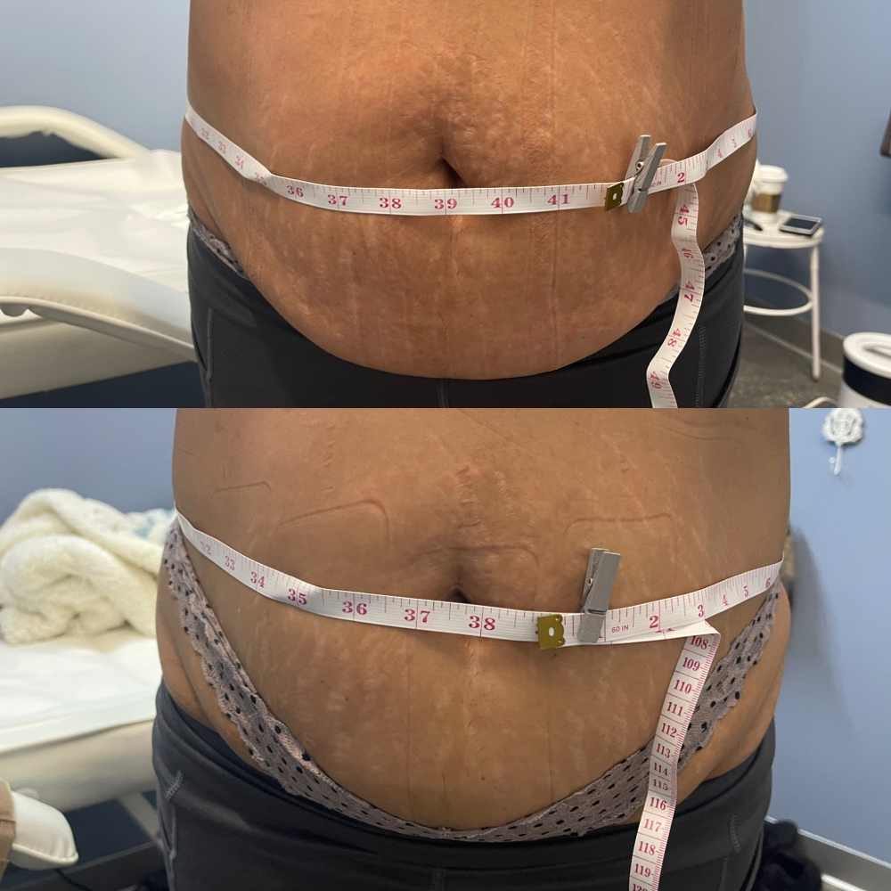 Laser Lipo  (6 Sessions)