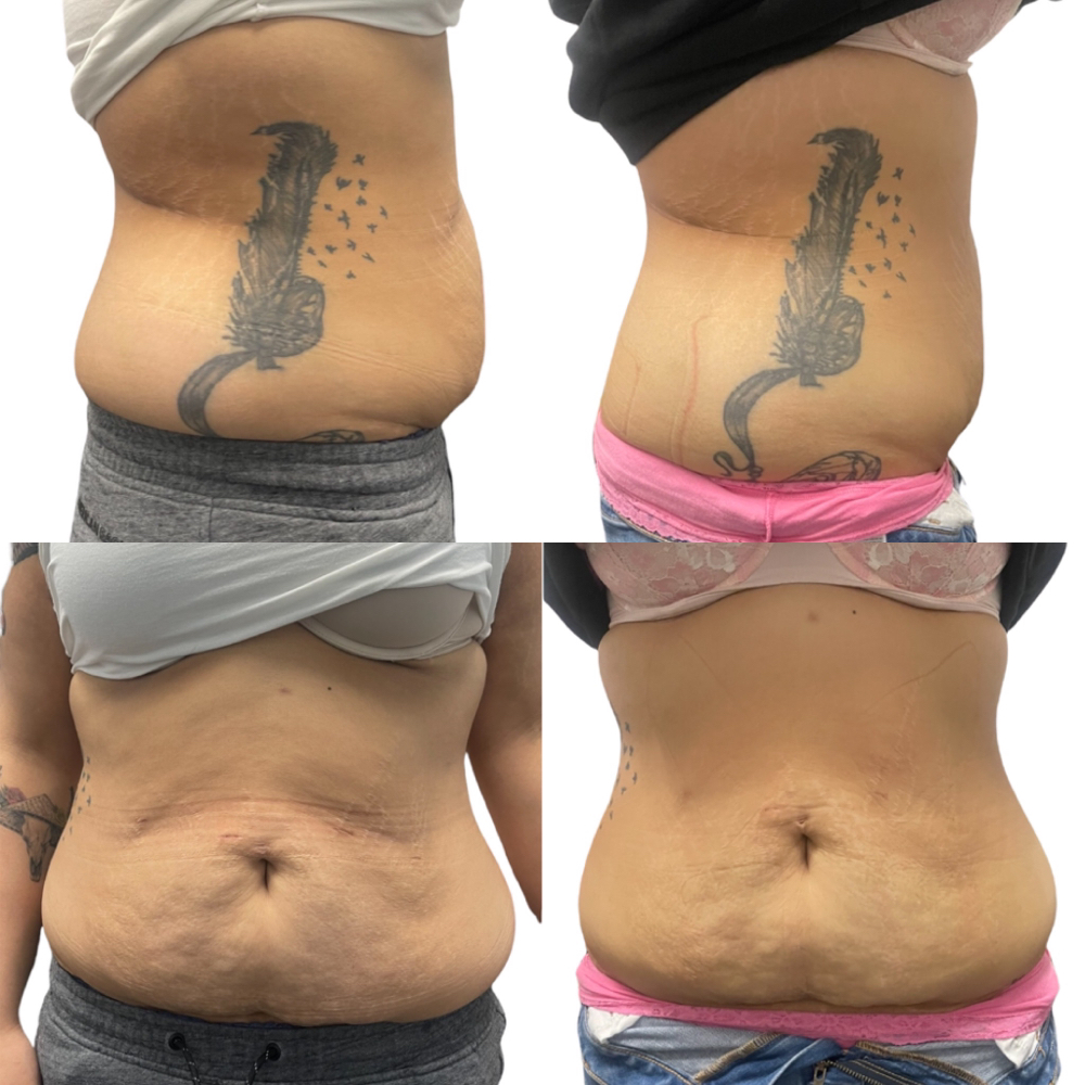 Laser Lipo  (12 Sessions)