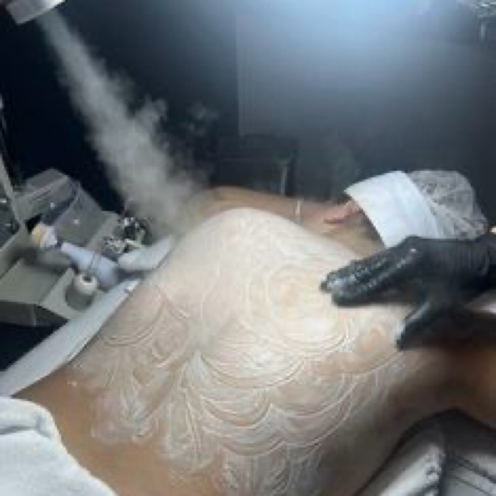 Back Acne Facial at Dynasty House Of Beauty in Los Angeles, CA