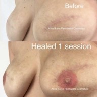 Areola restoration 6 week touch up