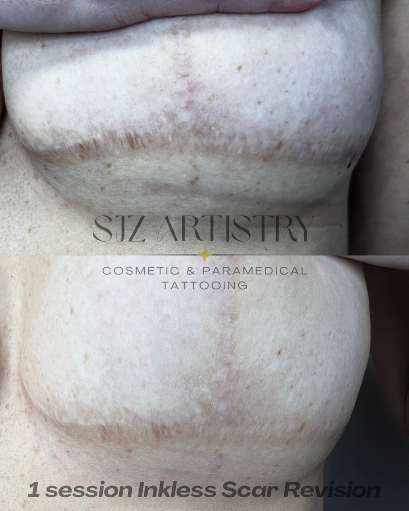 Inkless Scar Revision