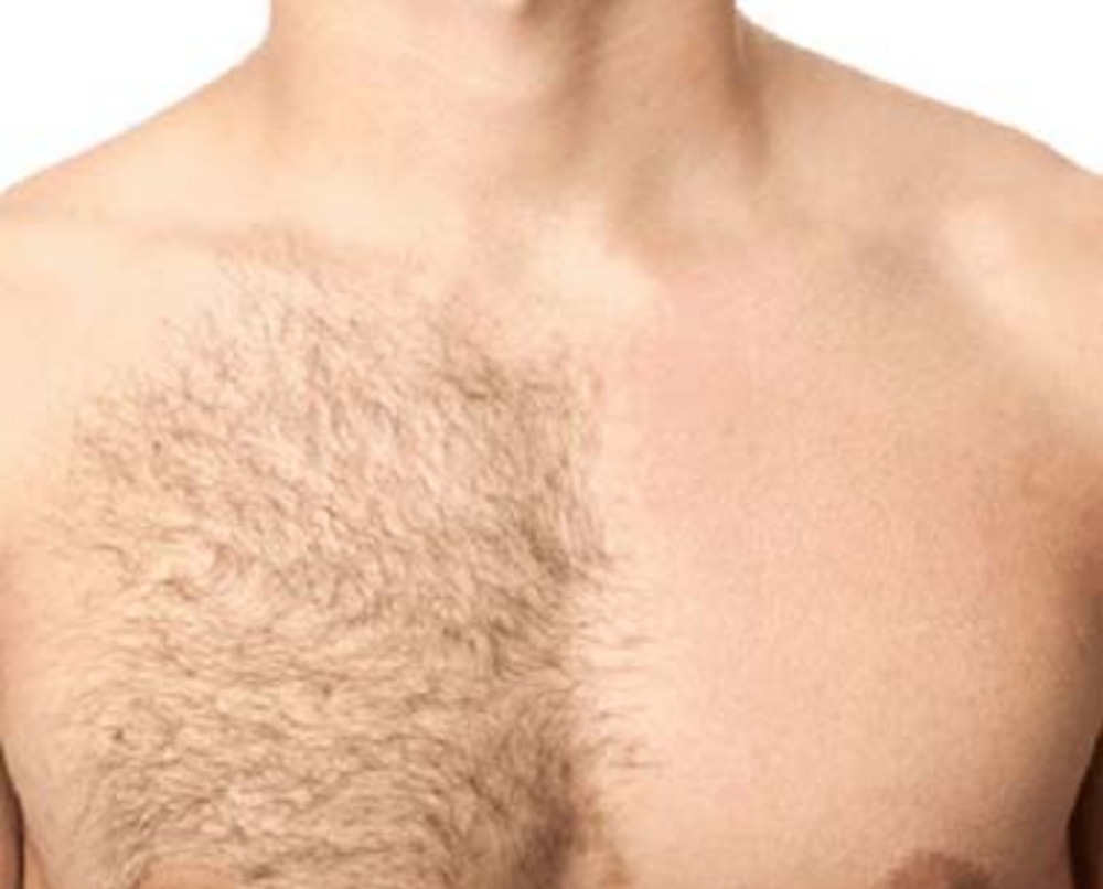 Chest And Stomach Hair Removal (AT)