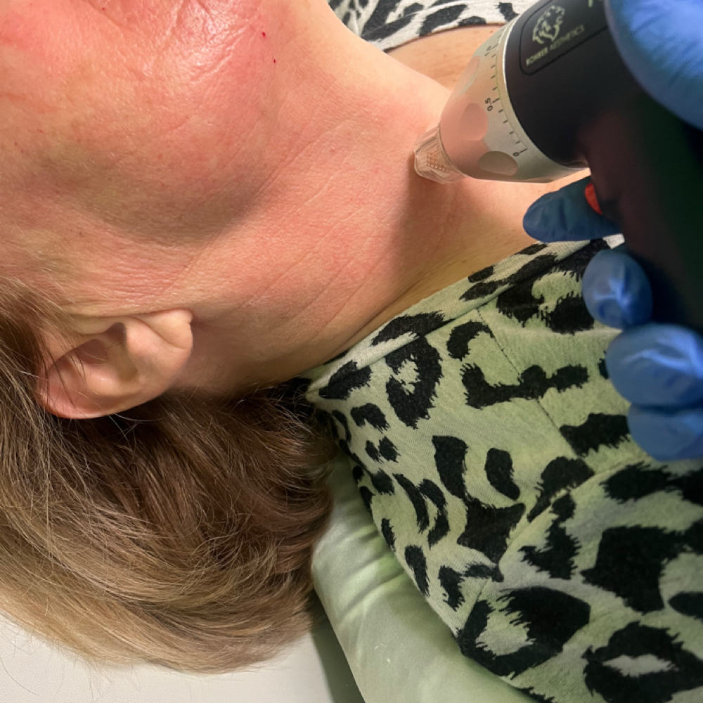 Radiofrequency Microneedling at Genesis Health and Beauty Bar in Daphne, AL
