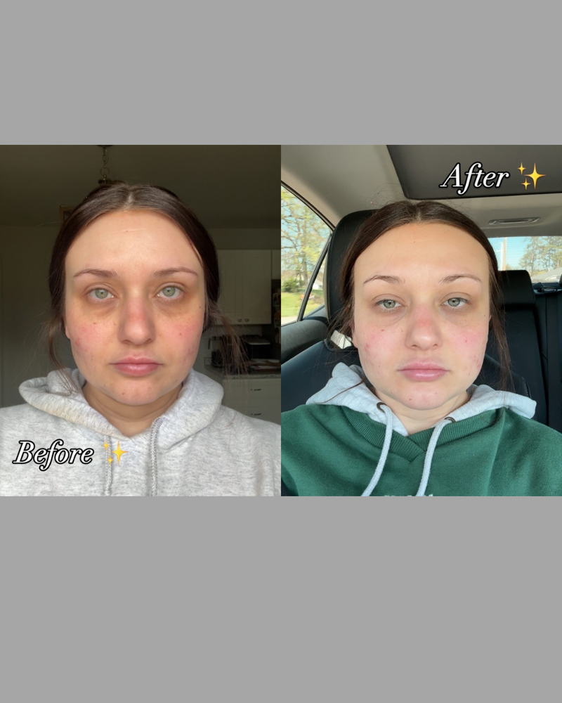Undereye PRP