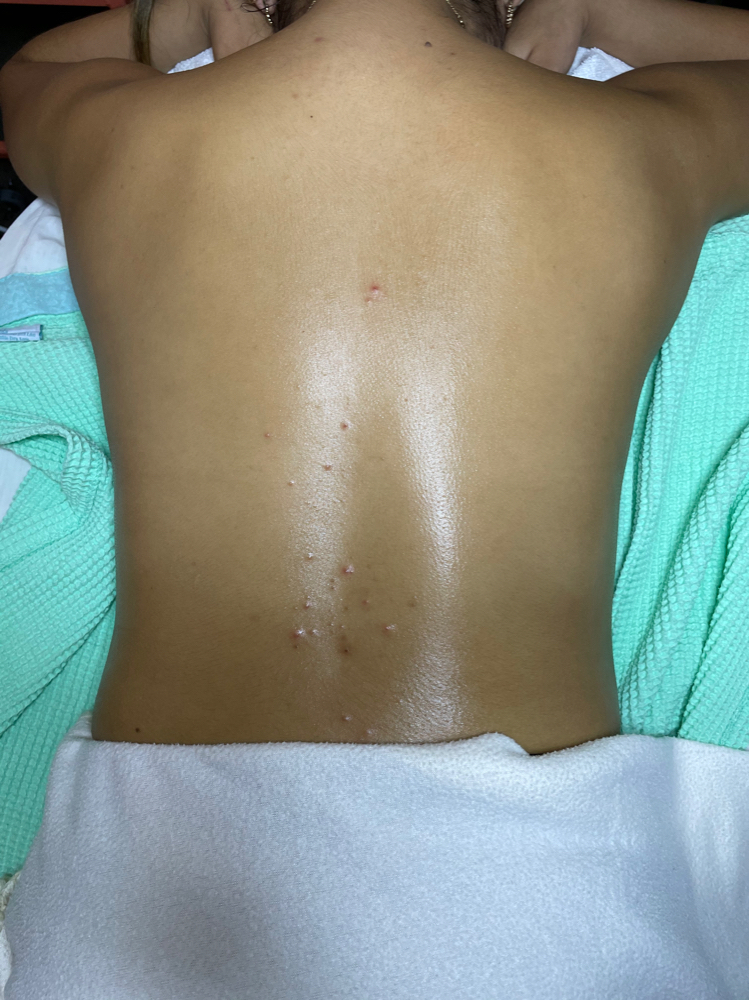 Detoxifying Back Facial