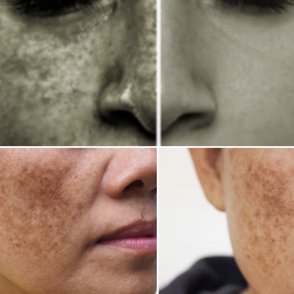 Pigmentation Correction