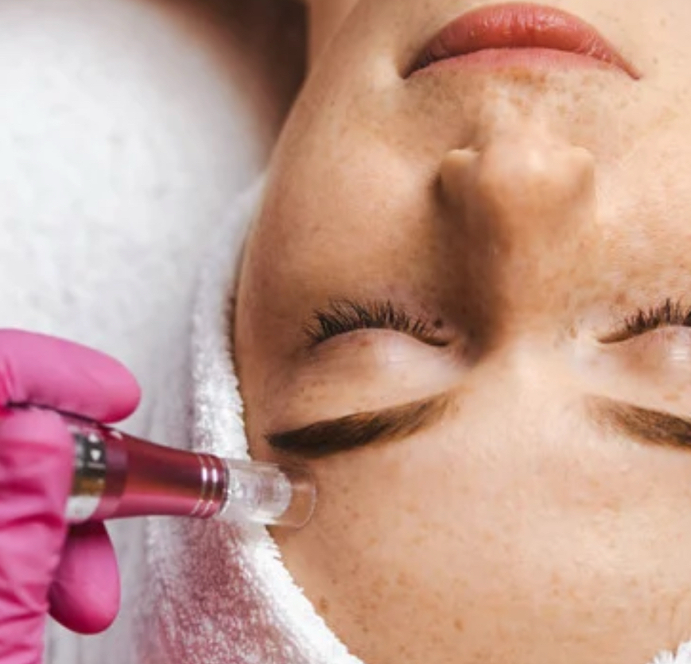 Microneedling