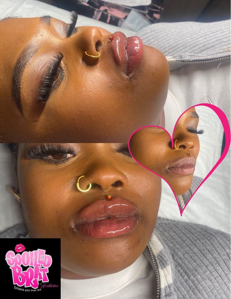 2ML RUSSIAN/BRAT LIP FILLER