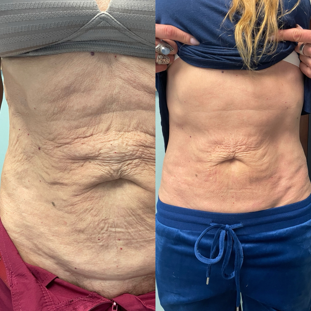 Exillis Ultra Belly