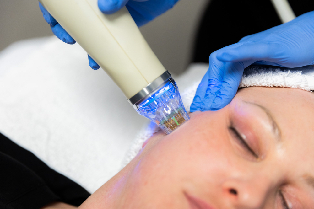 3-in-1 Microneedling Facial