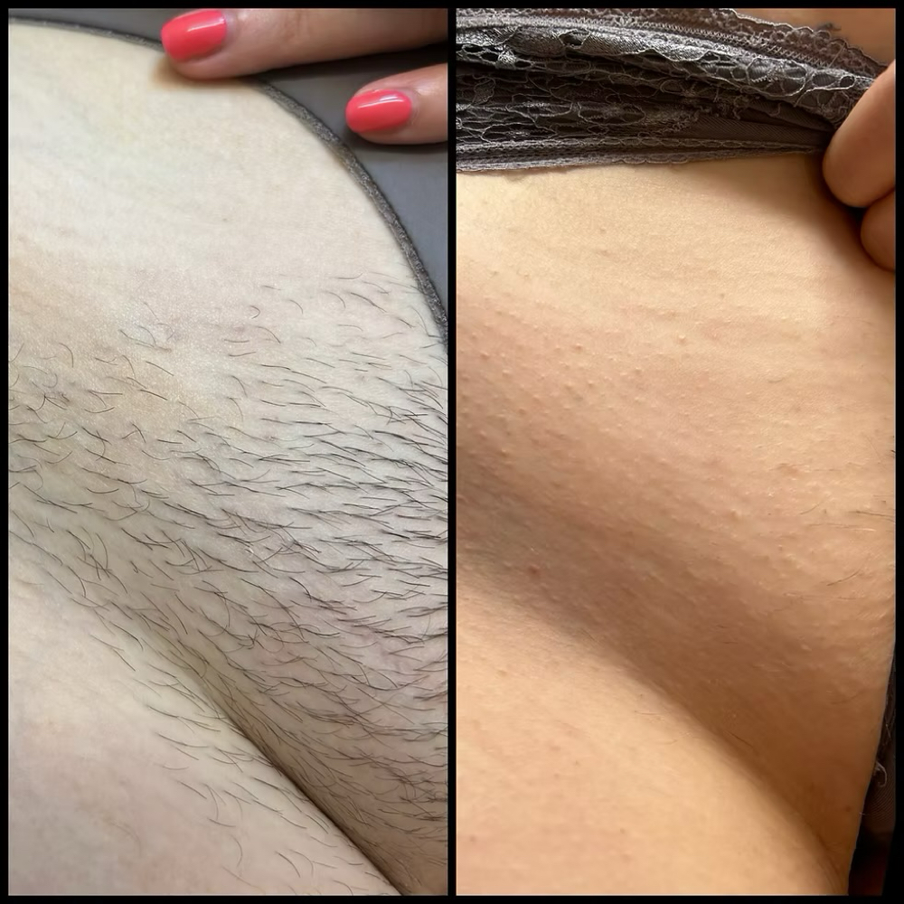 Brazilian Laser - 5 Sessions at Blessed & Bare Laser Studio in New York, NY