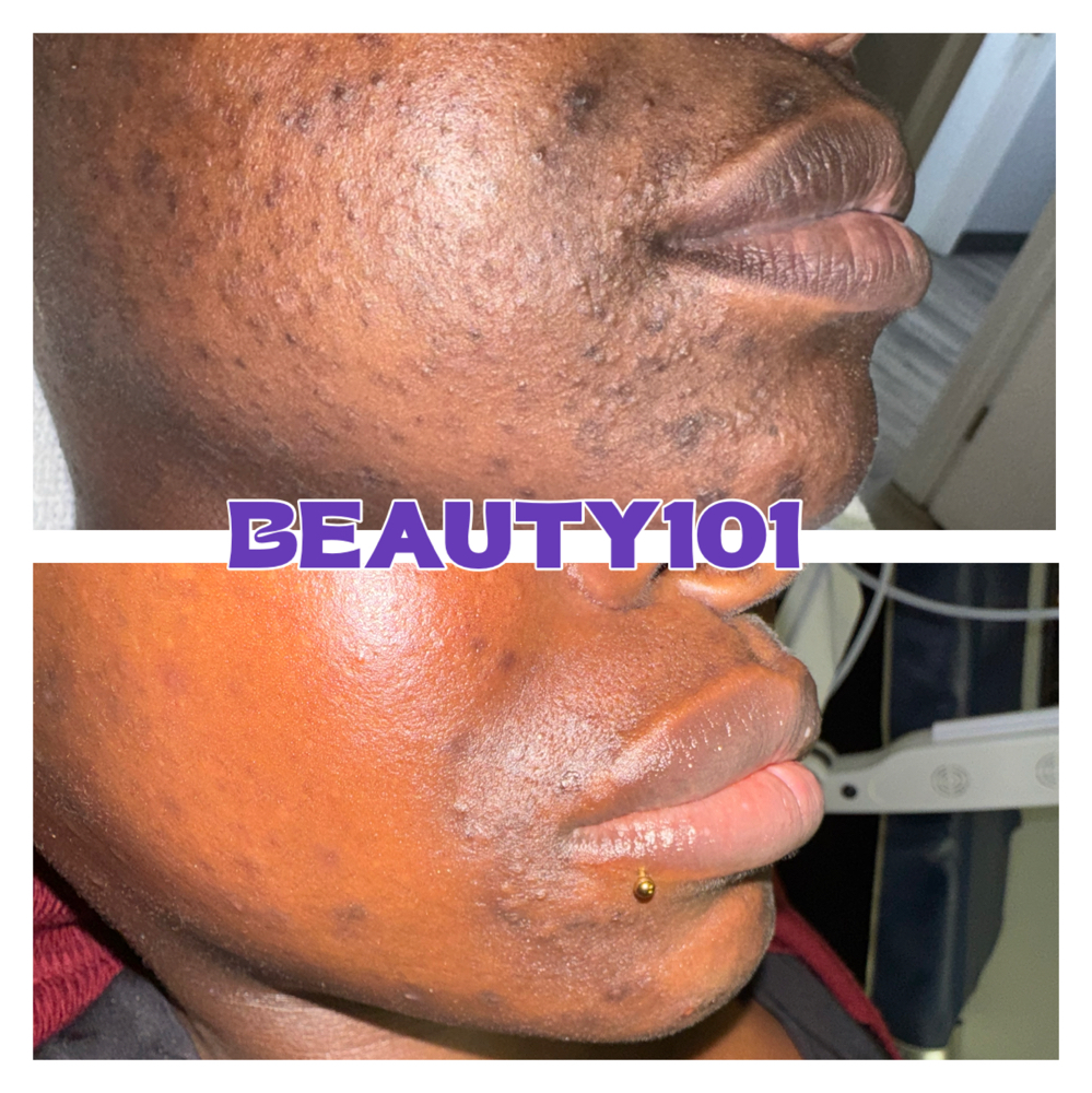 GG- Chemical Peel series