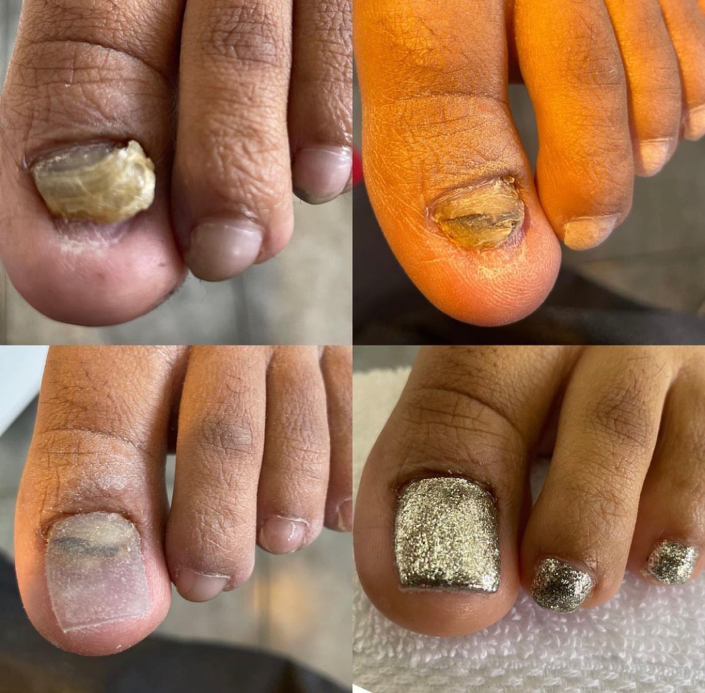 Toenail Reconstruction A La Carte