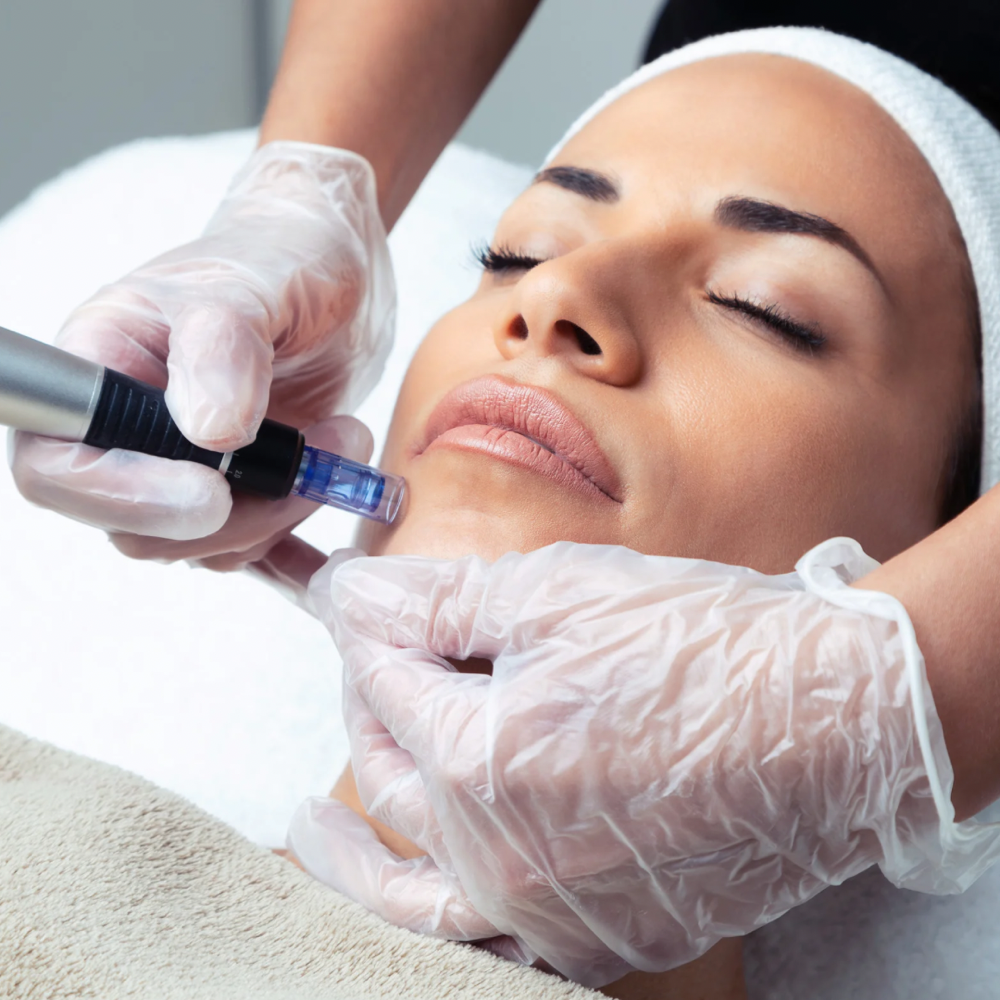 Microneedling