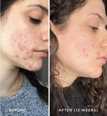 High Frequency Treatment Add On