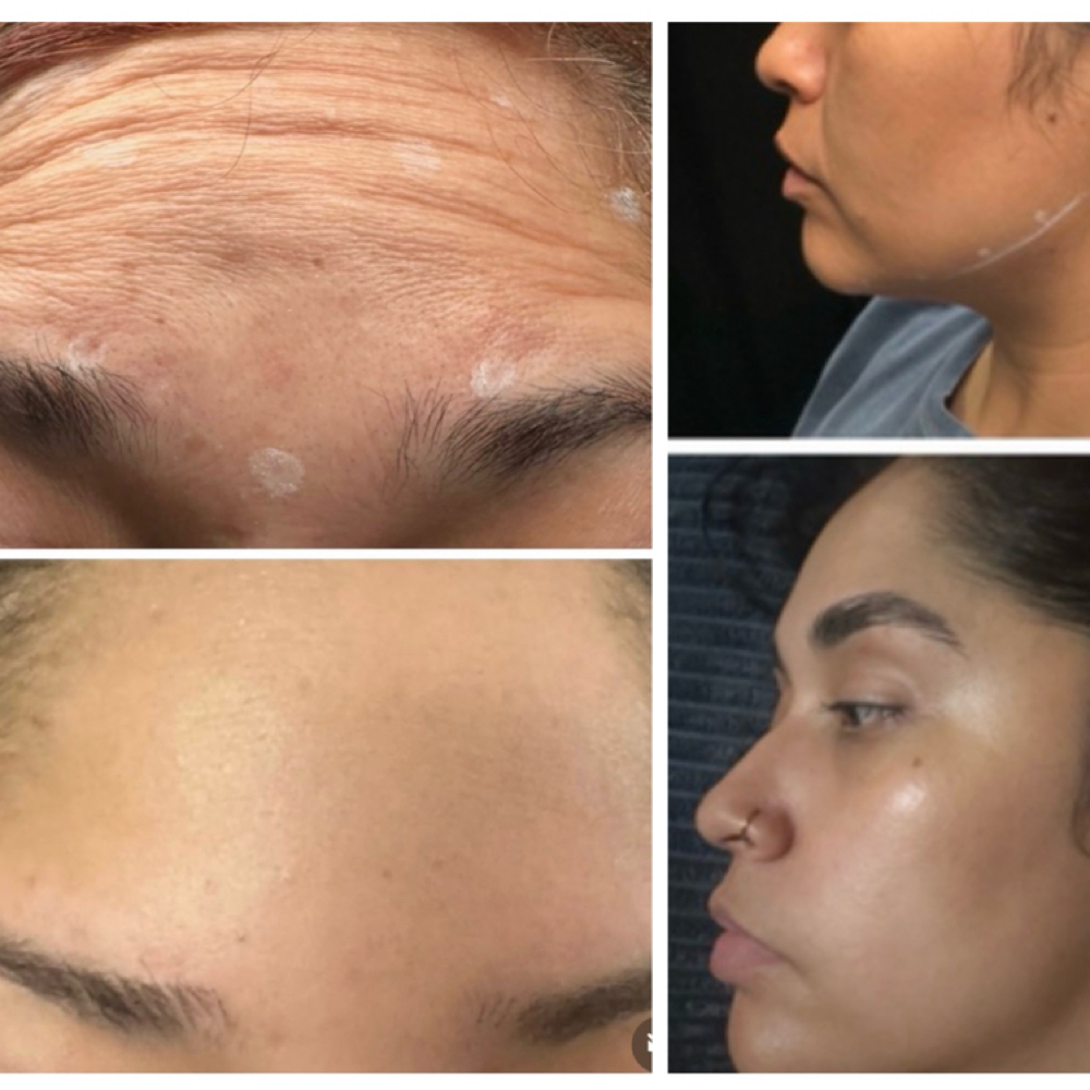 Injectables- Botox at T&N Skin Med Spa Inc in Abington, PA