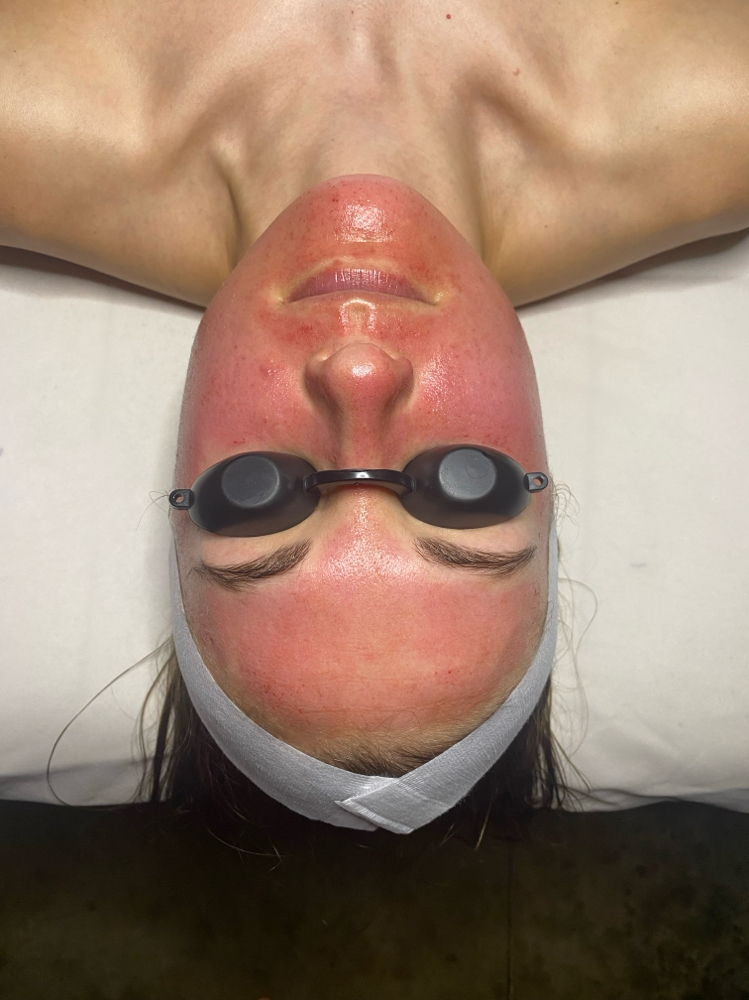 Microneedle Sessions at Reset Studio in Springfield, MO