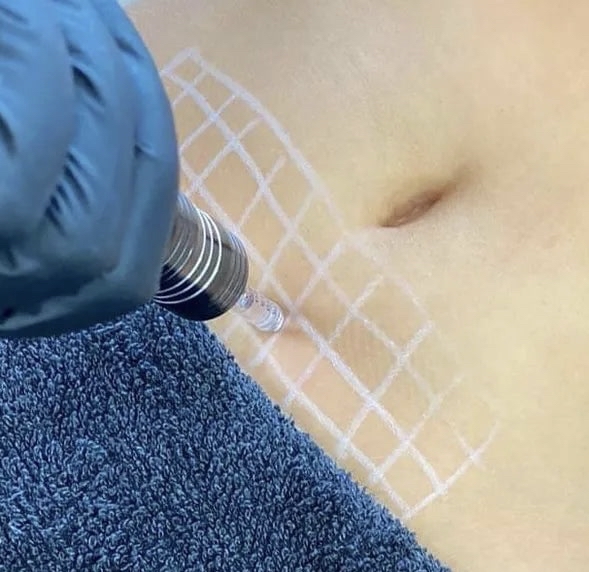 Fat Dissolve Per Area