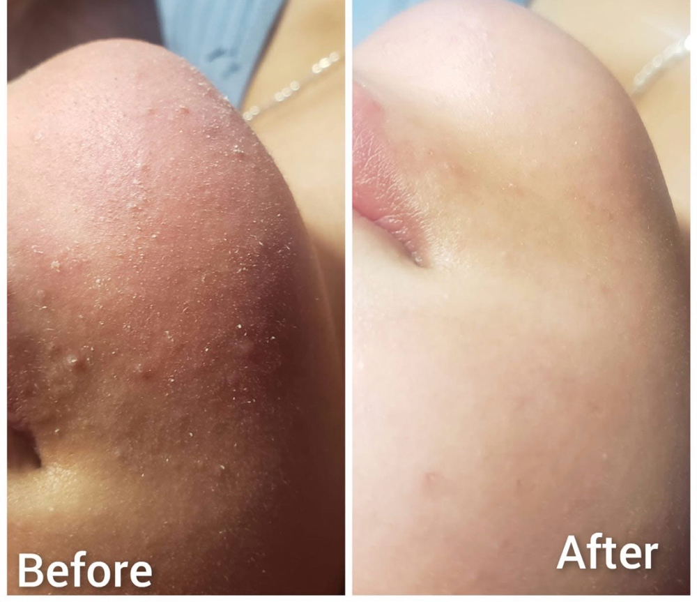Diamond microdermabrasion facial at Beauty Esthetics Loft in Denver, CO