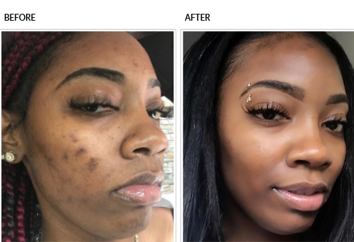Chemical peel