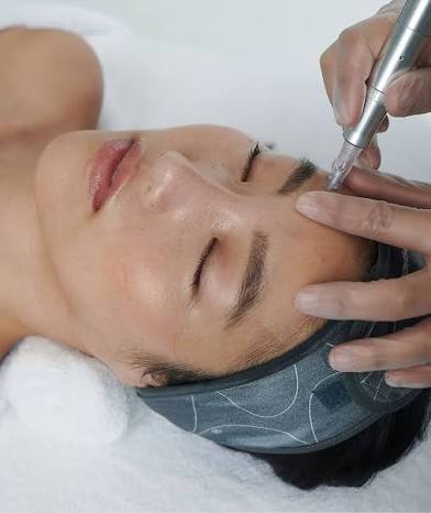 Microneedling