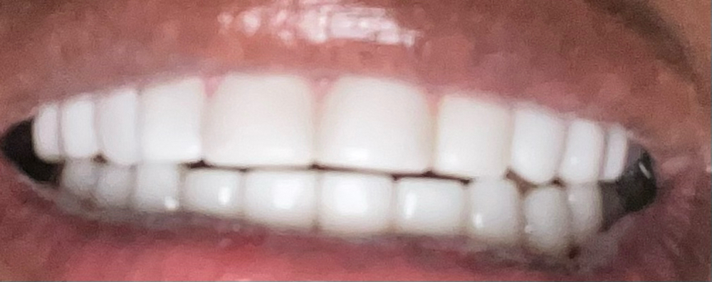 Cosmetic Veneers