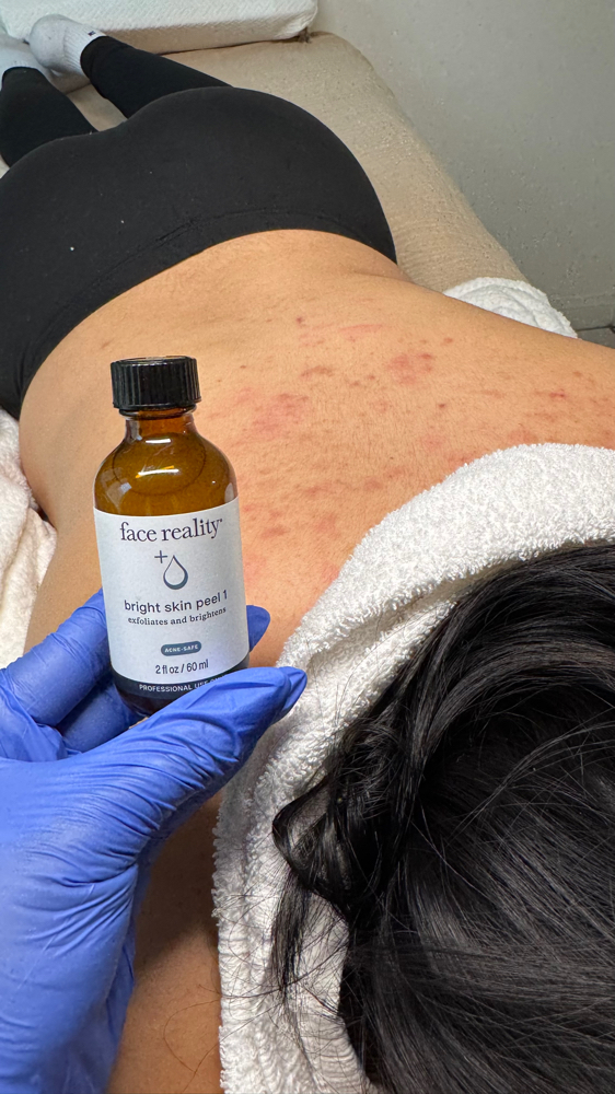 Back Facial / Peel at Karla Espinoza in Downey, CA
