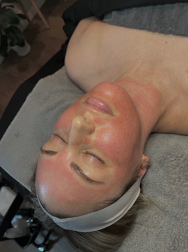 Microneedling Neck Add-On