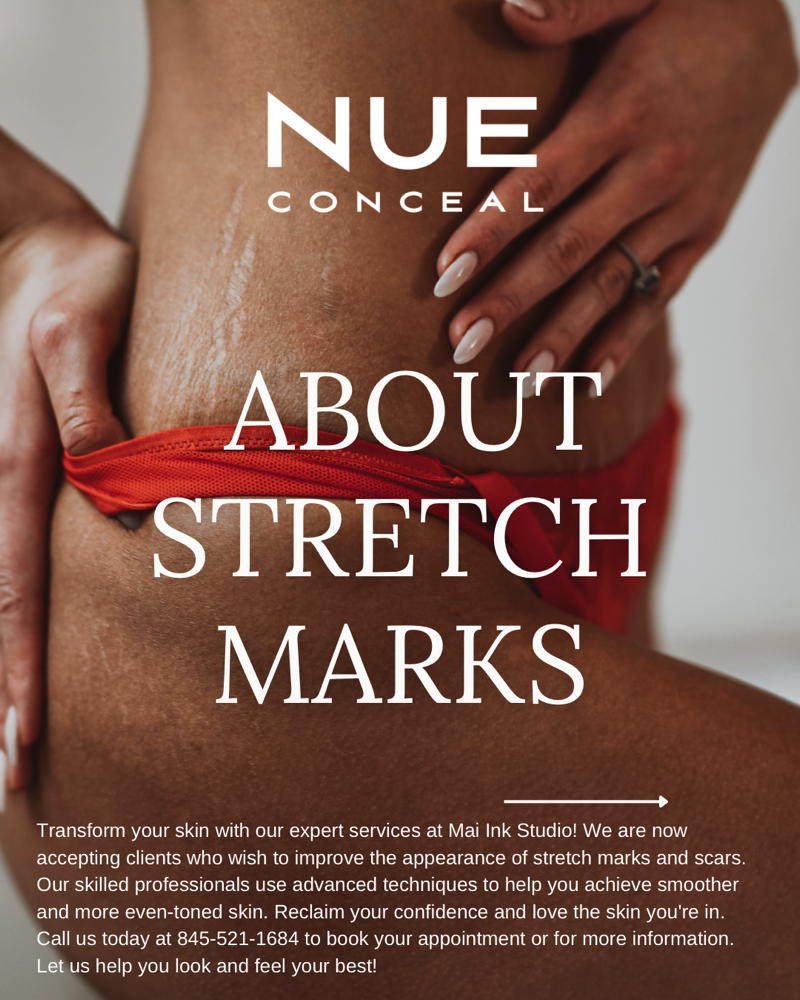 Inkless stretchmark Conceal