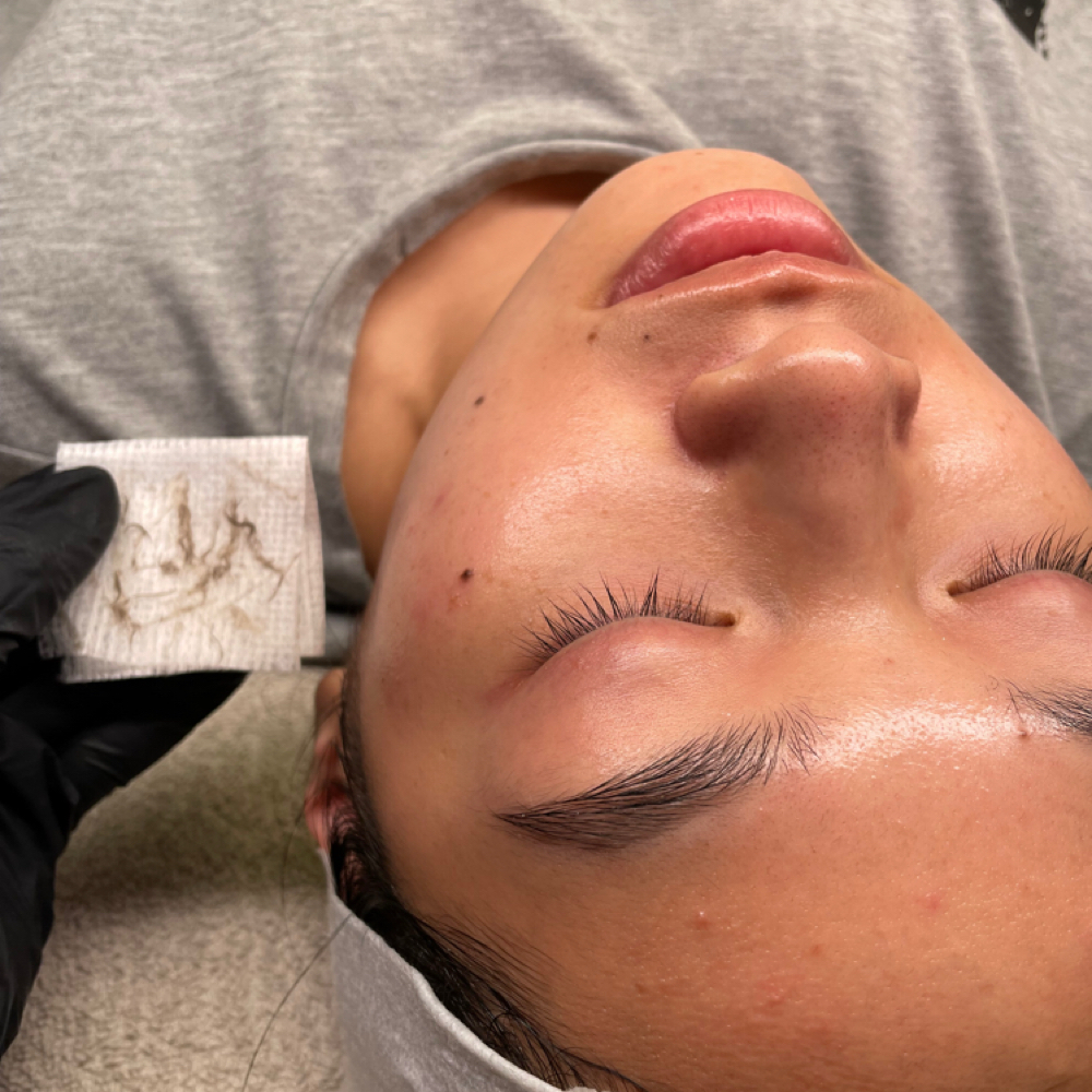 Dermaplaning at Blooming Daysi Aesthetics in Clovis, CA
