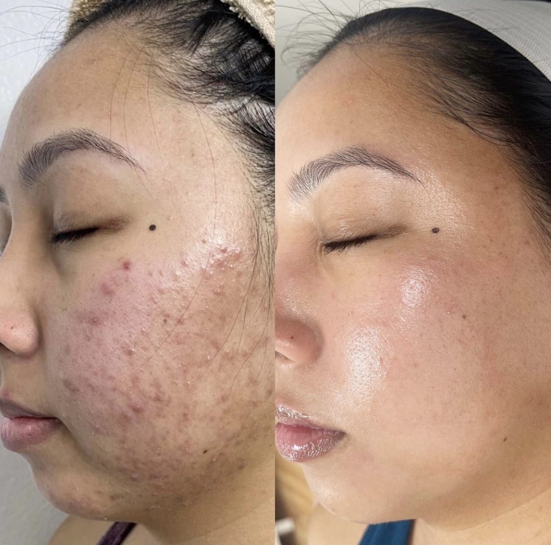 Acne Facial at Plum Artistry & Esthetics, llc. in Peachtree Corners, GA
