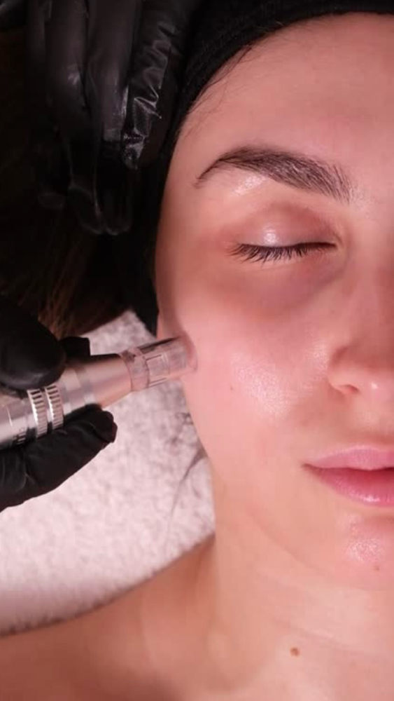 Medical-Grade Microneedling at Wave Wellness & Aesthetics RBNY in Belle harbor, NY