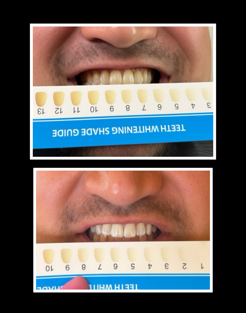 Cosmetic Teeth Whitening