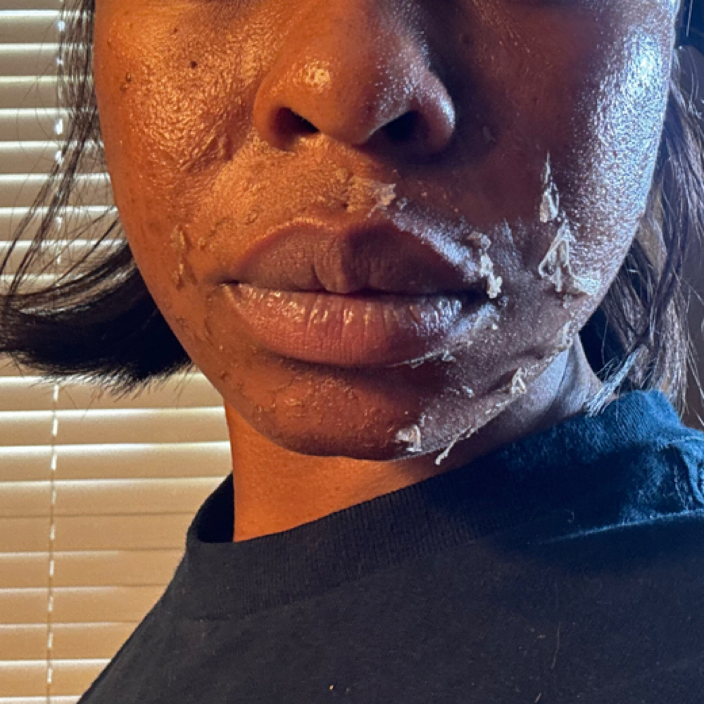 5 Layer Chemical Peel (Jessner) at Beauty Therapy by Chanel in Tucker, GA
