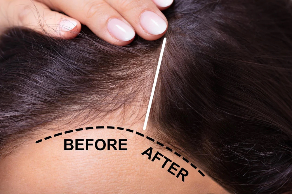 Scalp Microneedling