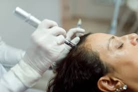 Scalp Microneedling