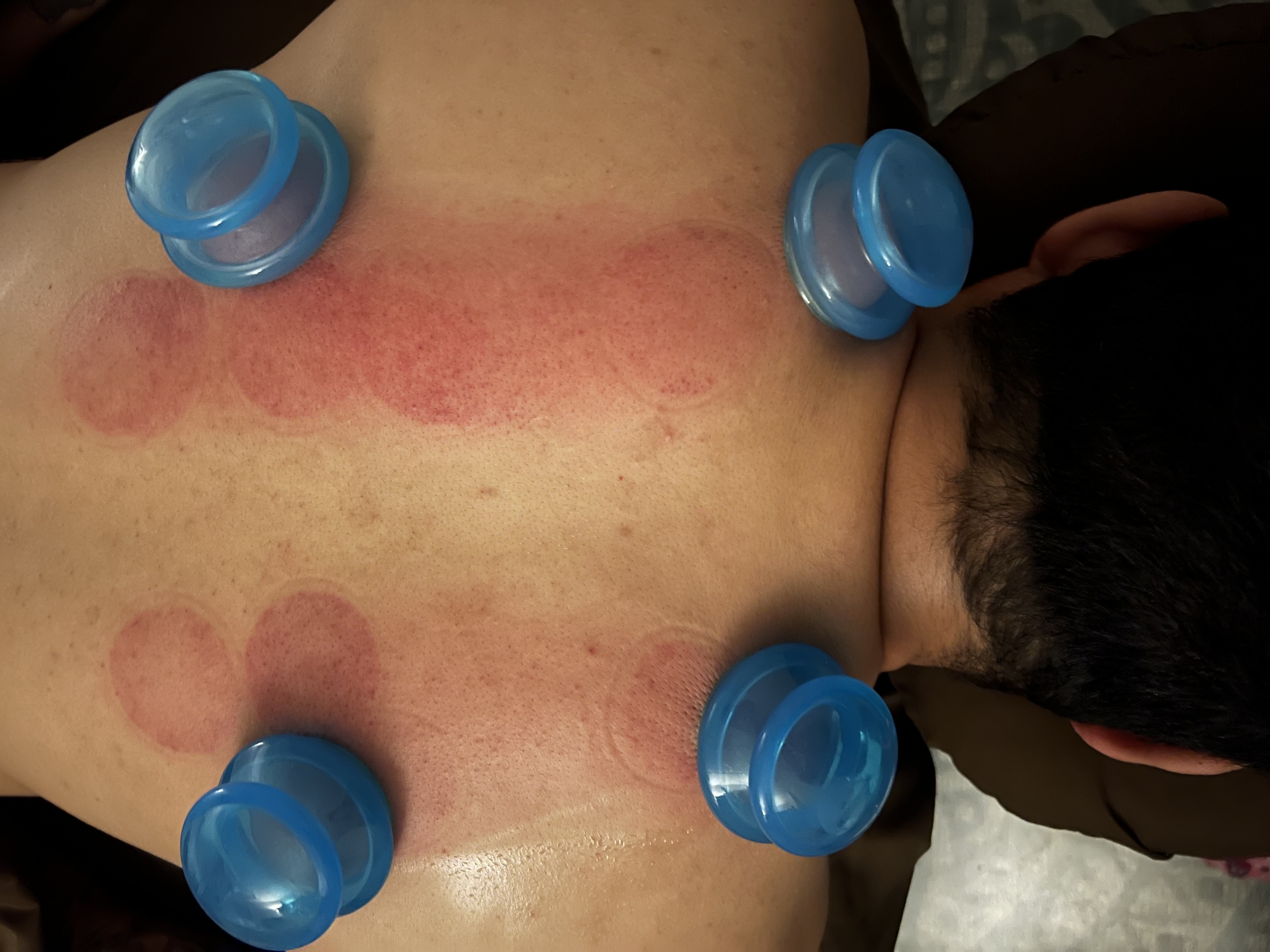 Cupping Massage