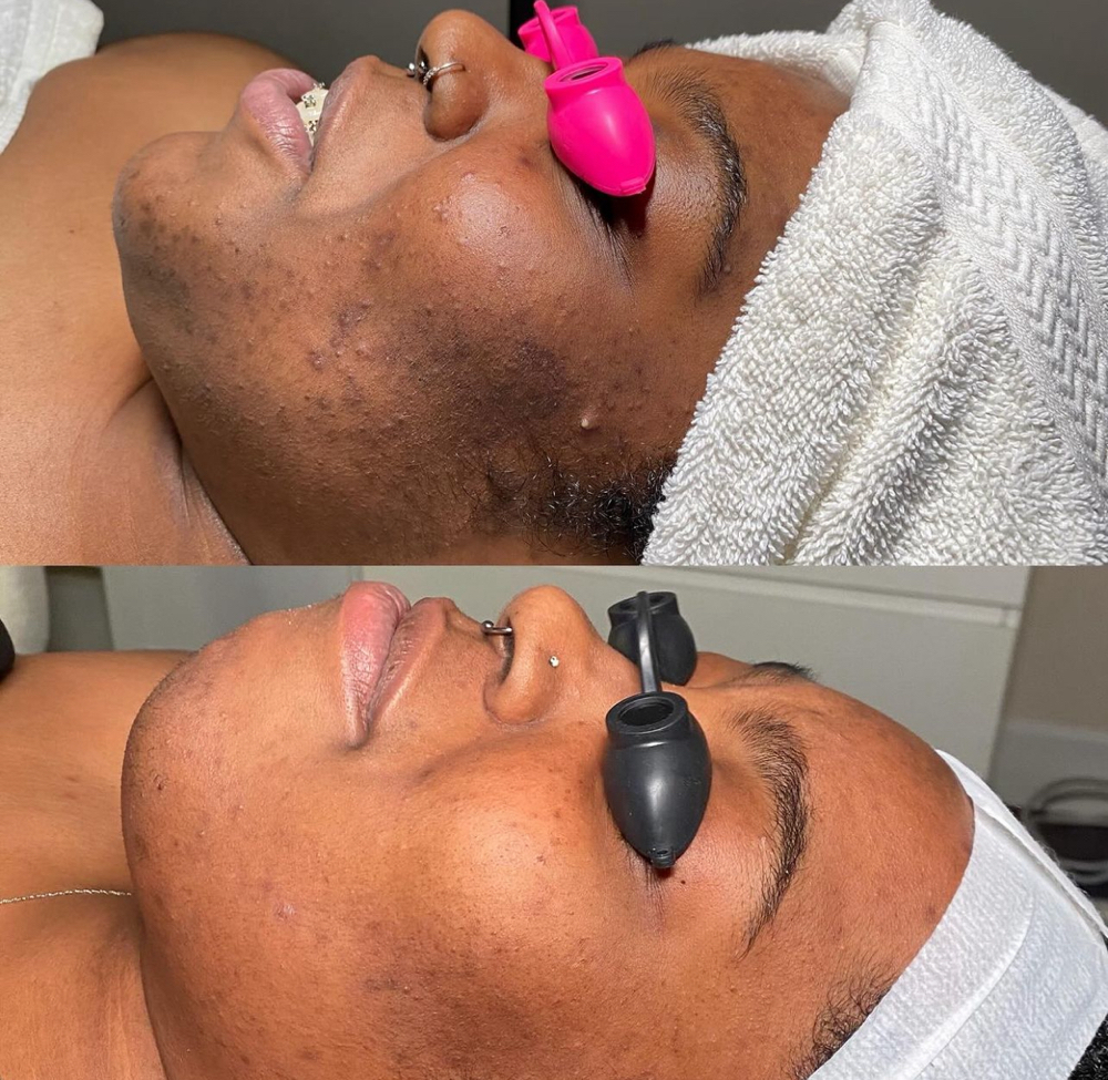 Calming Acne Facial