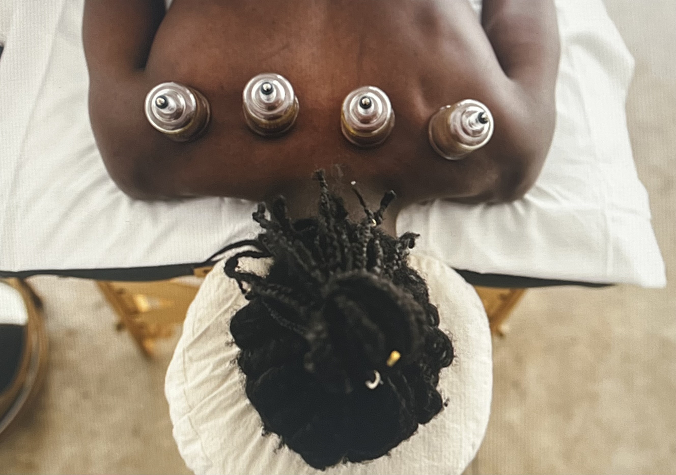 Cupping