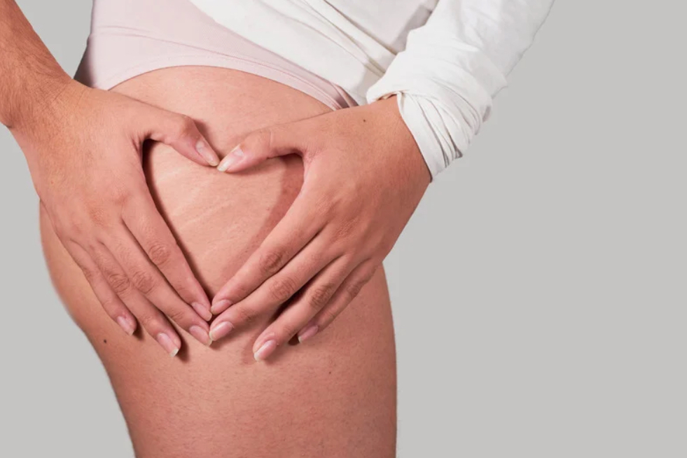 Front & Outer Thigh Stretchmark