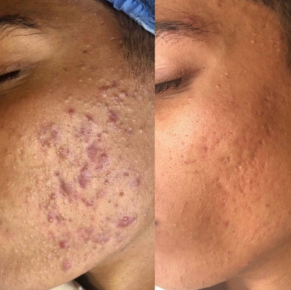 Acne Treatment at SiempreBellasBeautySpa in North Miami, FL