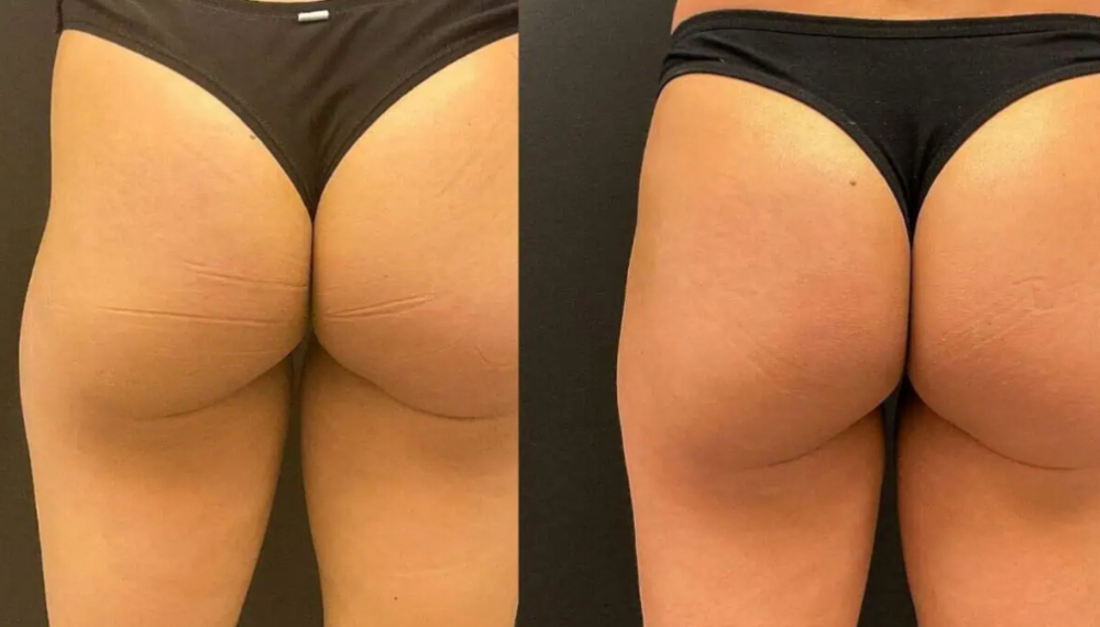 The Perfect Butt Consultation