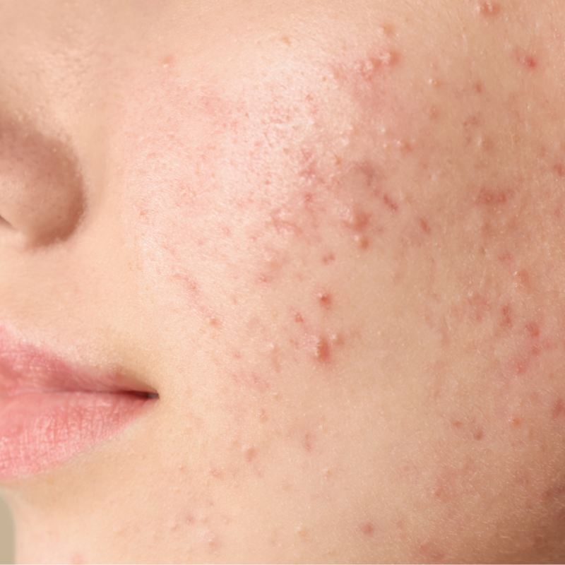 The Clarity (Acne Focused) at Skin + Soma Esthetics in National City, CA
