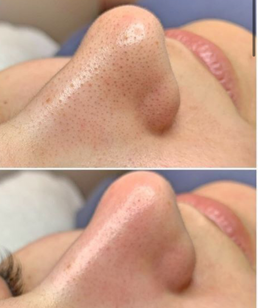 Extractions