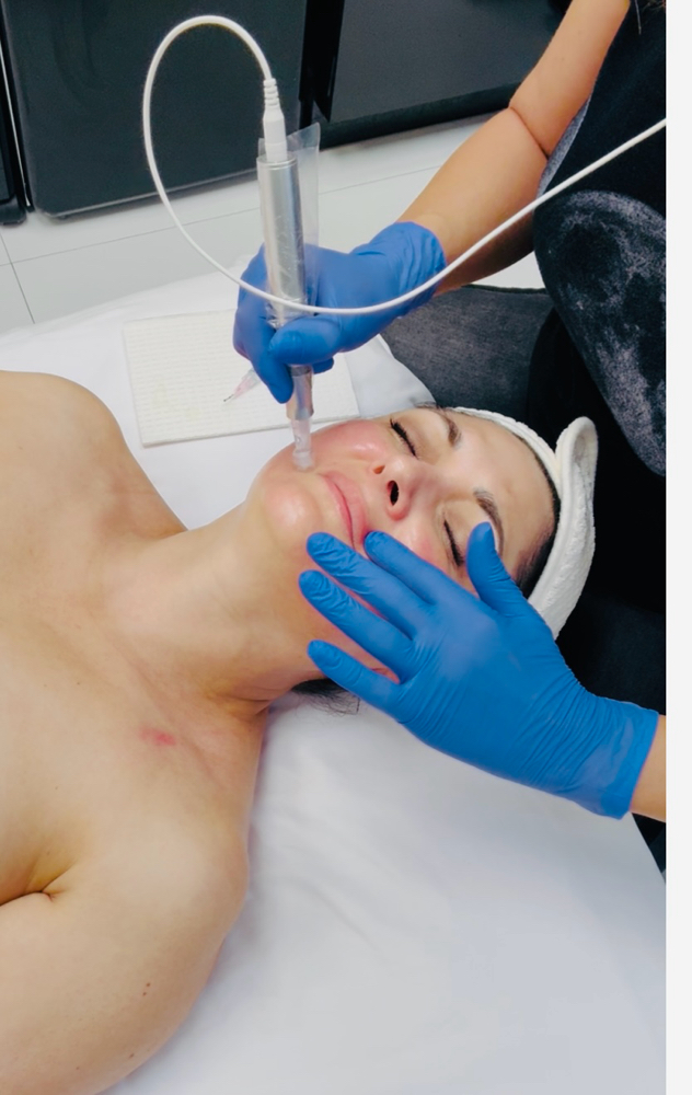 Microneedling at Marina Novak in North Palm Beach, FL