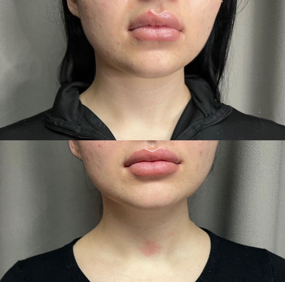 Chin & Jawline Contour (1 SESSION)