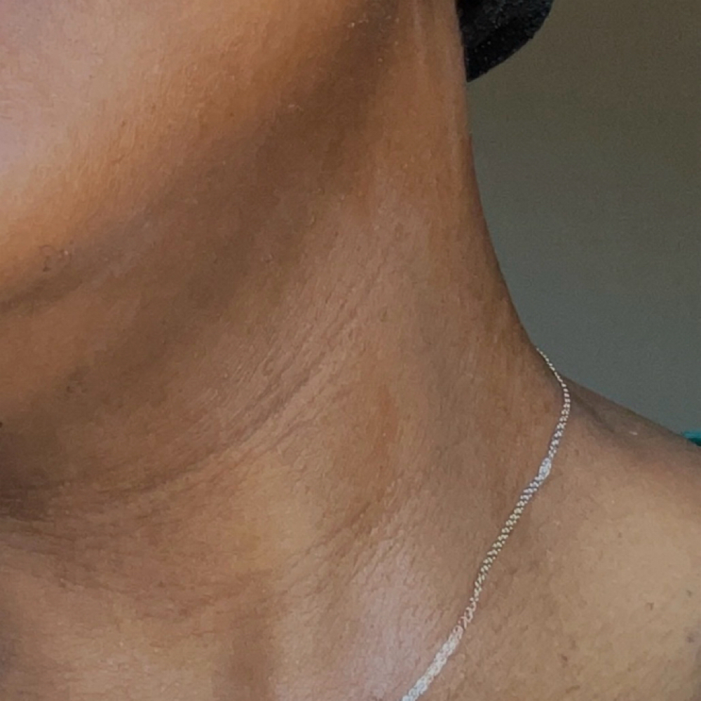 Procell Collagen Neck & Décolletage at Prime Skin Esthetics in Belleville, NJ