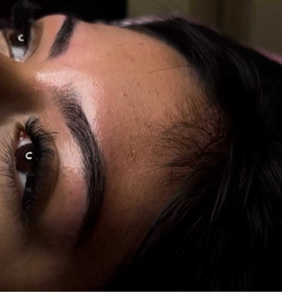 Brow at 5StarEsthetics in Minneapolis, MN
