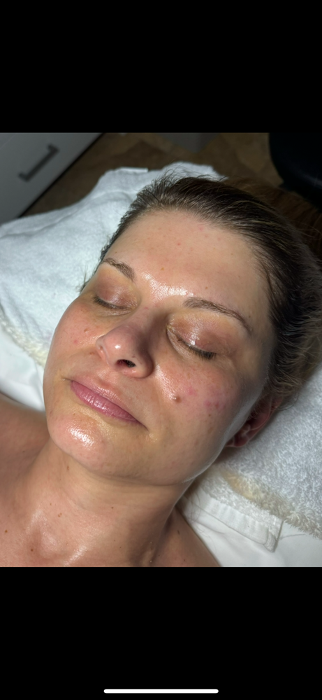 Microdermabrasion