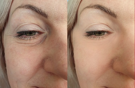 RF Facial Tightening (3) Session
